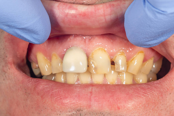 ceramic crowns of human teeth closeup macro isolate on black bac - Photo, Image