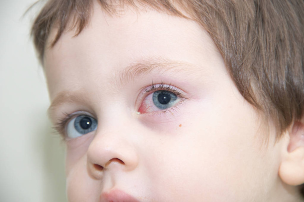 conjunctivitis in the eye of a child. Ophthalmic diseases. Red eye . Vessels burst in the eye. - Photo, Image