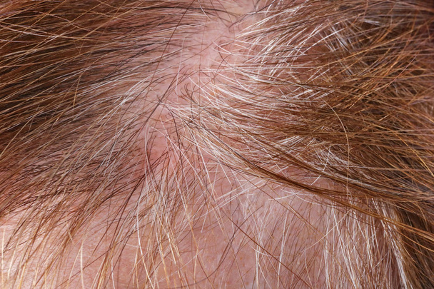 Dolor de piel grasa y pelo gris escaso en la cabeza de una persona mayor e
 - Foto, Imagen