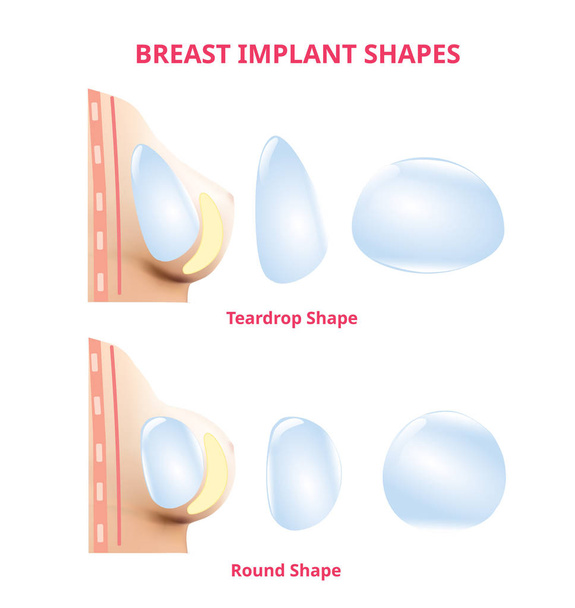 Implantes mamarios de silicona, comparar ronda y lágrima gota, vector de diseño realista
. - Vector, imagen