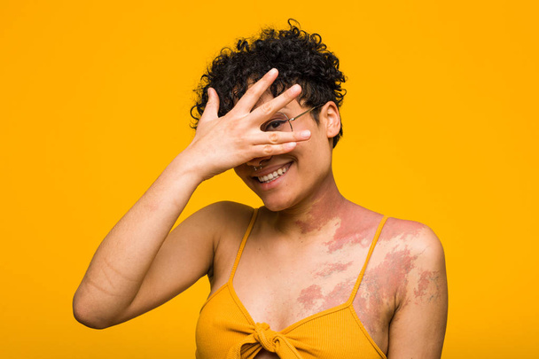 皮膚の出生マークを持つ若いアフリカ系アメリカ人女性が指を通してカメラで点滅し、恥ずかしい顔を覆う. - 写真・画像