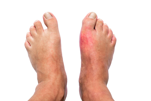 Homem com o pé direito inchado e dor de gota inflamação isolada no fundo branco
 - Foto, Imagem