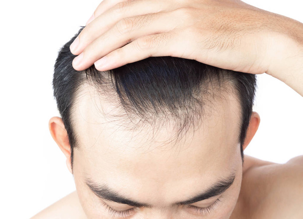 Young man serious hair loss problem for health care medical and shampoo product concept, selective focus - Photo, Image