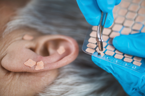 Аурикулотерапия, или ушная терапия на ухе человека, закрывается. Рука терапевта наносит наклейку с иглоушными семенами пинцетом
. - Фото, изображение