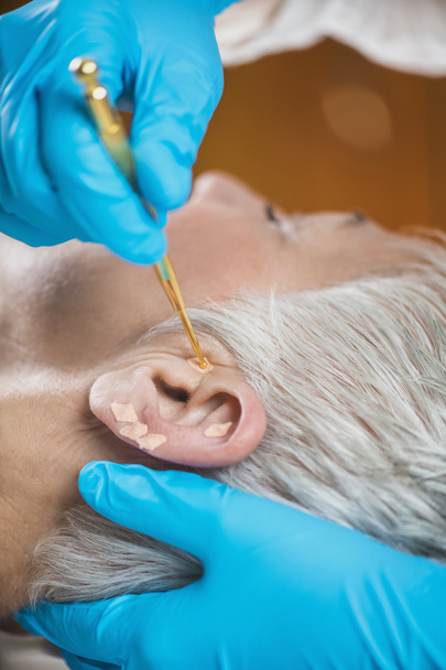 L'auriculothérapie, ou traitement auriculaire sur l'oreille humaine, se referme. main thérapeute appliquant acupuncture épi autocollant de graines avec une pince à épiler
. - Photo, image