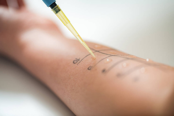 Allergy - Skin Prick Tests on a Womans Arm  - Photo, Image