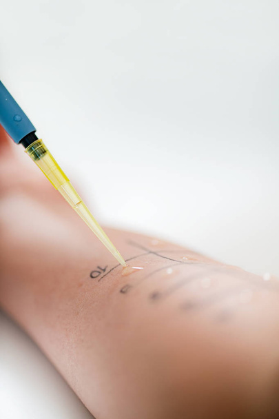 Alergia: prueba de pinchazo cutáneo en un brazo de mujer
  - Foto, Imagen