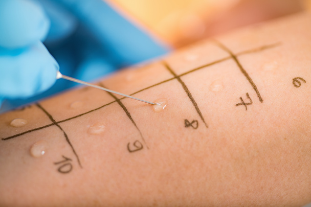 Immunológus csinálás bőr prick allergia teszt egy Womans ARM  - Fotó, kép
