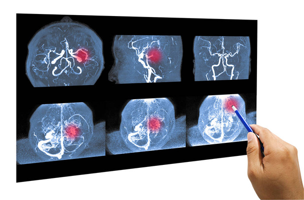Mra agy vagy mágneses rezonancia angiográfia az agyi artéria . - Fotó, kép