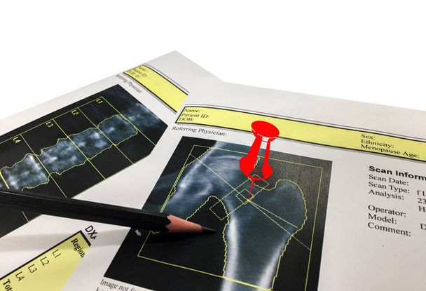 Csípő és gerinc csontsűrűség (Bmd) Dexa denzitometria csípővizsgálat - Fotó, kép