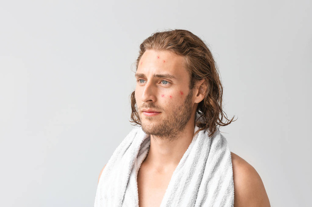 Ritratto di giovane uomo con problema di acne su sfondo chiaro
 - Foto, immagini