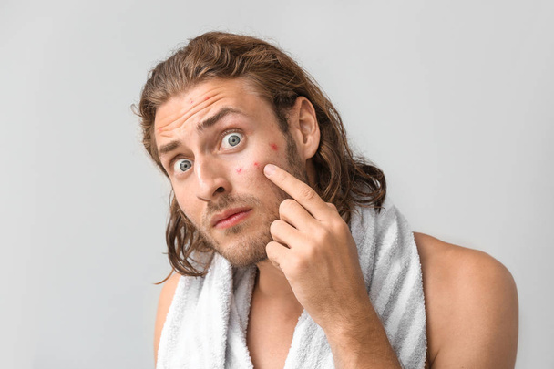 Ritratto di giovane uomo con problema di acne su sfondo chiaro
 - Foto, immagini