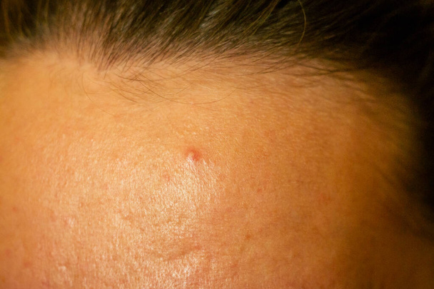 acné, cicatrices y granos rojos supurantes en la cara de una mujer joven. concepto de problemas de la piel y fallo armónico
 - Foto, imagen