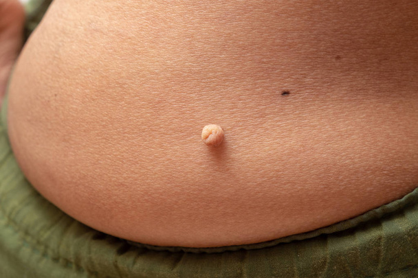 Skin Tag, Acrochondon on Female Skin. Skin Tag Removal Surgery - Photo, Image