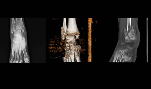 Röntgenbild und CT-Scan des rechten Knöchels zeigen Spiralfraktur der distalen - Foto, Bild