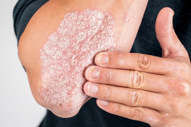 o uso de emoliente para pele seca escamosa, como no tratamento de
  - Foto, Imagem