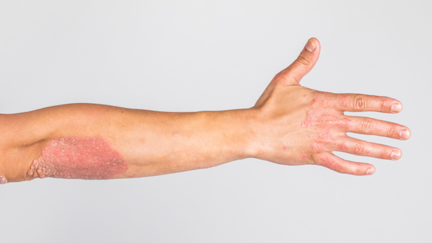 病気の手を持つ男、下品なサイザーで手に乾燥したフレーク状の皮膚 - 写真・画像