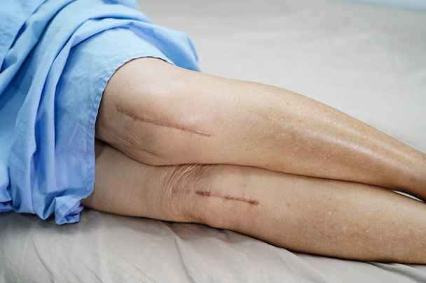 Азиатская пожилая или пожилая женщина пациентка показывает свои шрамы хирургической полной замены коленного сустава хирургия швов артропластика раны на кровати в стационарном отделении: здоровый сильный медицинский концепт - Фото, изображение