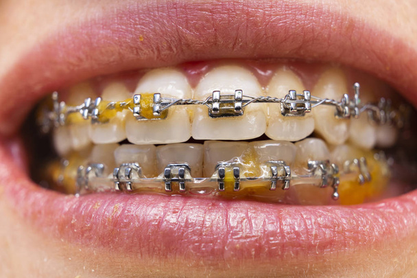 Dents en gros plan avec accolades. Photo de soins dentaires. Femme sourire avec des accessoires ortodontiques. Traitement orthodontique
. - Photo, image