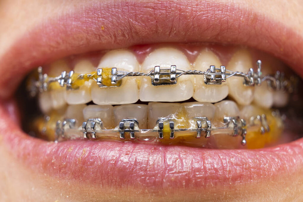 Dientes cercanos con aparatos ortopédicos. Foto de cuidado dental. Mujer sonrisa con accesorios de ortodoncia. Tratamiento de ortodoncia
. - Foto, Imagen