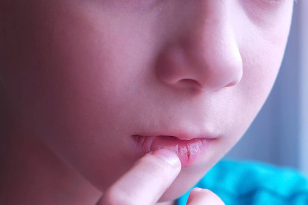 Child boy with herpes sore on the lip louches his lip, mouth closeup. - Photo, image