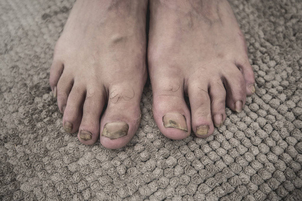 Ringworm is a disease caused by fungi that can affect the skin, nails. Foot very sick. - Photo, Image