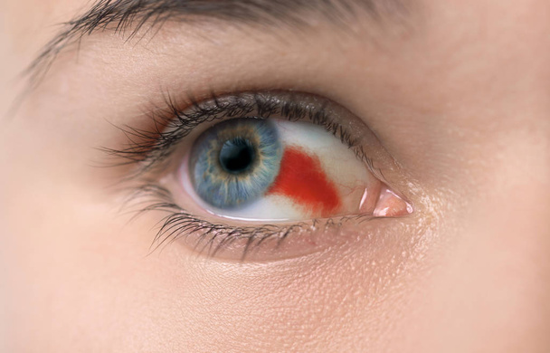 burst blood vessel in eye - Photo, Image