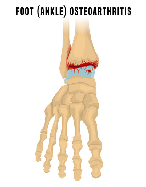 Obrázek artritidy nohy - Vektor, obrázek