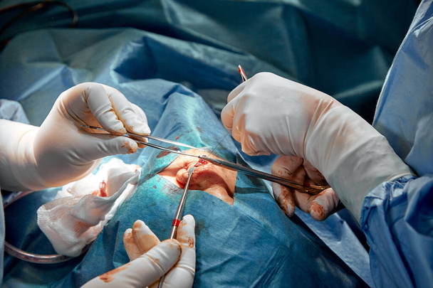 Nasenkorrektur aus nächster Nähe. Bei einer echten Operation führt ein Team von Chirurgen eine Operation an der Nase durch. moderne Medizin, Gesundheit. - Foto, Bild