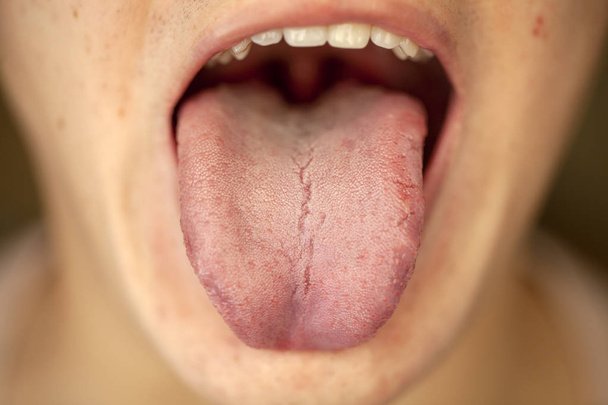 protruding white plaque on tongue, closeup - 写真・画像