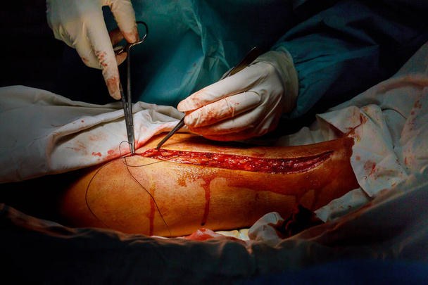 Operation von Krampfadern Beinchirurgie durch den Chirurgen im Operationssaal - Foto, Bild