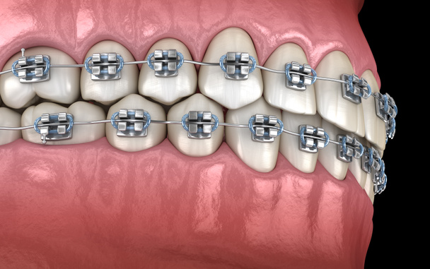 Dientes sanos con tirantes de metal. Ilustración dental 3D médicamente precisa
 - Foto, Imagen