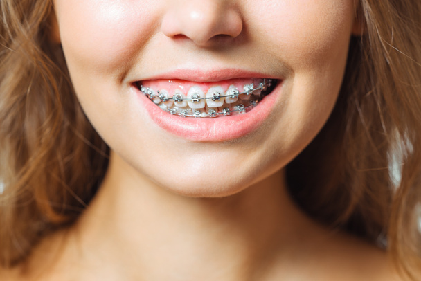 Orthodontische behandeling. Tandheelkundige zorg concept. Mooie vrouw gezonde glimlach close-up. Closeup keramische en metalen beugels op tanden. Mooie vrouwelijke glimlach met beugels. - Foto, afbeelding