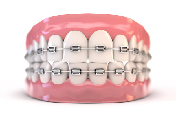 Fake Zähne mit Zahnspange - Foto, Bild