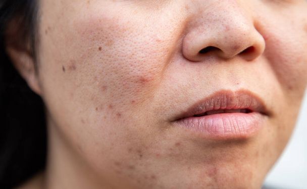 Problems facial skin is acne and blemishes. - Fotografie, Obrázek