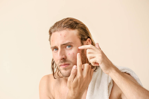 Portrait of young man with acne problem squishing pimples on color background - Photo, Image