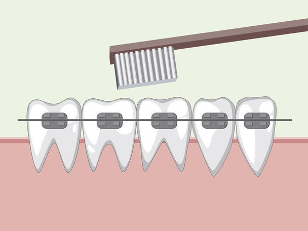 Vektorin hampaat hammasraudoilla ja hammasharjalla
 - Vektori, kuva