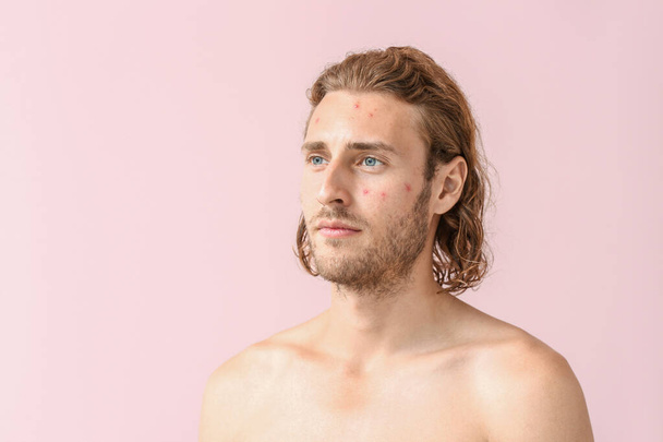 Retrato de homem jovem com problema de acne no fundo de cor
 - Foto, Imagem