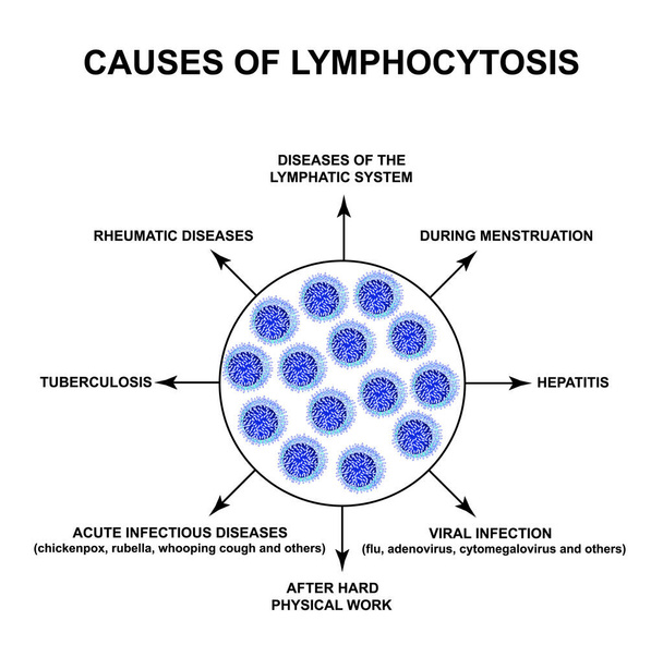 Causes of lymphocytosis. The increase in lymphocytes in the blood. Cell killers. Immunity Helper Cells. Infographics. Vector illustration on isolated background. - Vector, Image