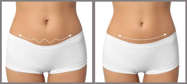 Mulher antes e depois da cirurgia plástica em fundo branco
 - Foto, Imagem
