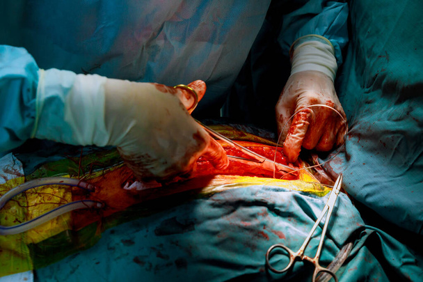 Bámul, hogy lezárja a has egy varrat a nyitott szívműtét - Fotó, kép