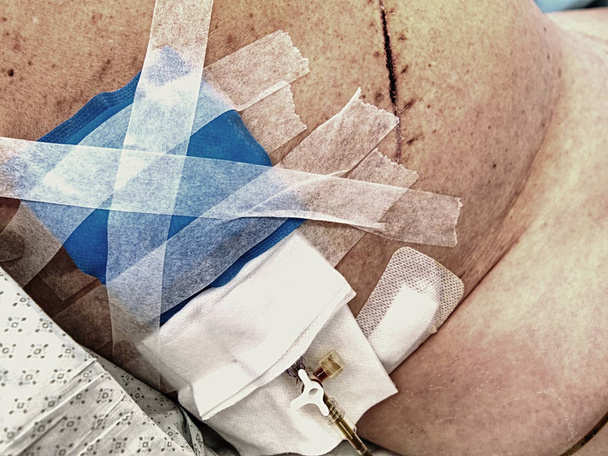 Cicatrice médicale après chirurgie du foie, ablation de la tumeur. Oncologie, cancer
 - Photo, image