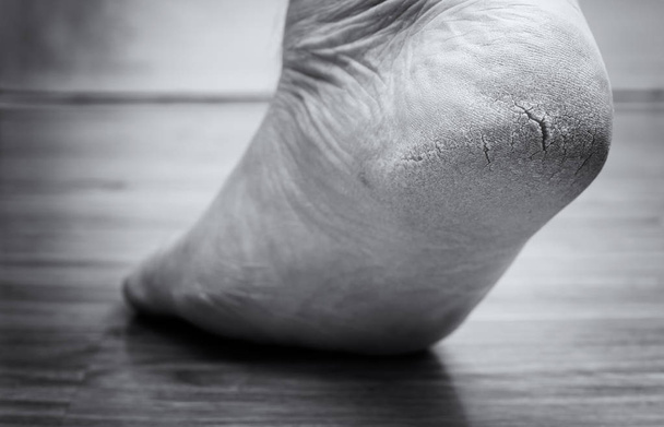 Gesloten van gebarsten hakken, ook bekend als kloven, een gemeenschappelijk voet probleem. zwarte en witte Toon - Foto, afbeelding