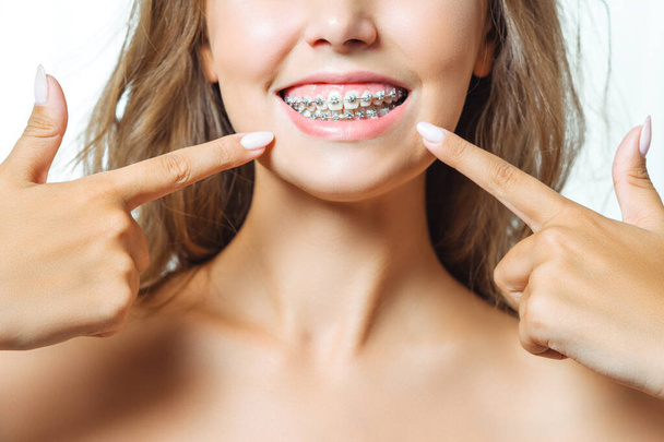 Orthodontic Treatment. Dental Care Concept. Beautiful Woman Healthy Smile close up. Closeup Ceramic and Metal Brackets on Teeth. Beautiful Female Smile with Braces. - Photo, image