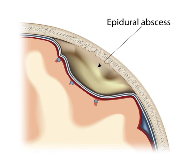 Epidural abscess vector - Vector, Image