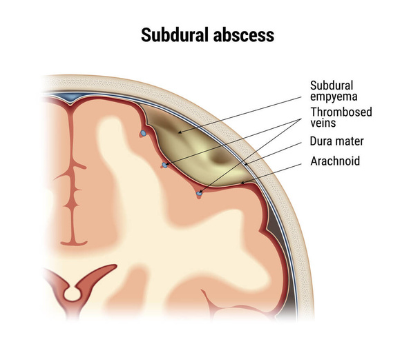 Subdural abscess vector - Vector, Image