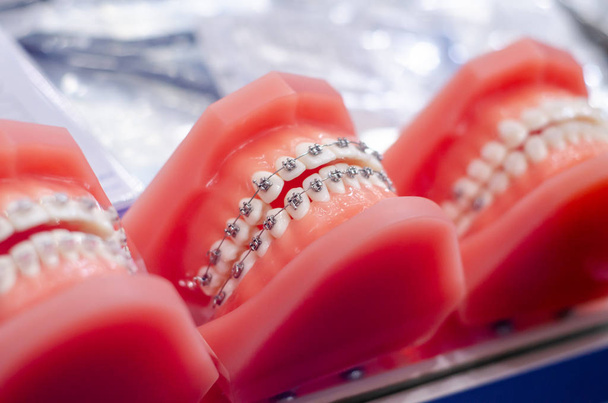 Demonstraatio hampaat malli oikomishoidon kiinnike tai tuki
 - Valokuva, kuva