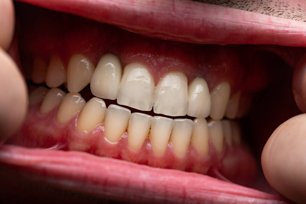 Foto do homem com a boca aberta, mostrando dentes
 - Foto, Imagem