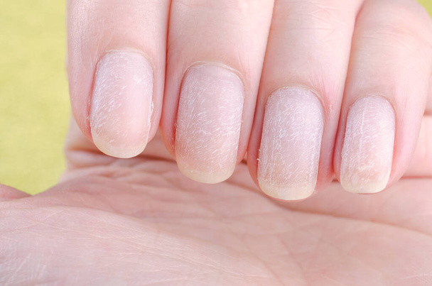 ongles endommagés après avoir enlevé le vernis à ongles gel moderne
 - Photo, image
