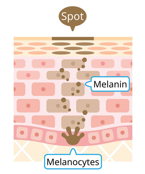human skin layer of melanin and facial dark spots. Infographic skin layer illustration. Beauty and skin care concept - ベクター画像
